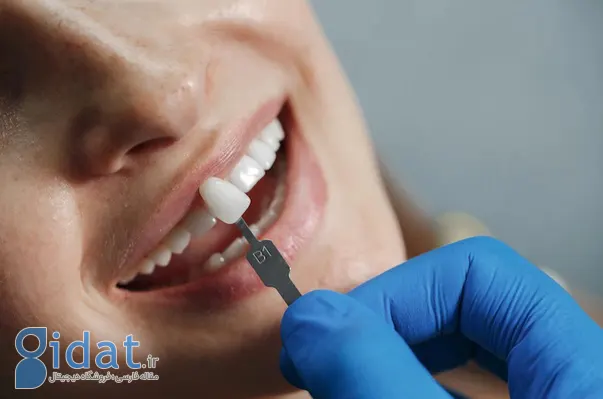 لمینت دندان فوری چیست؟